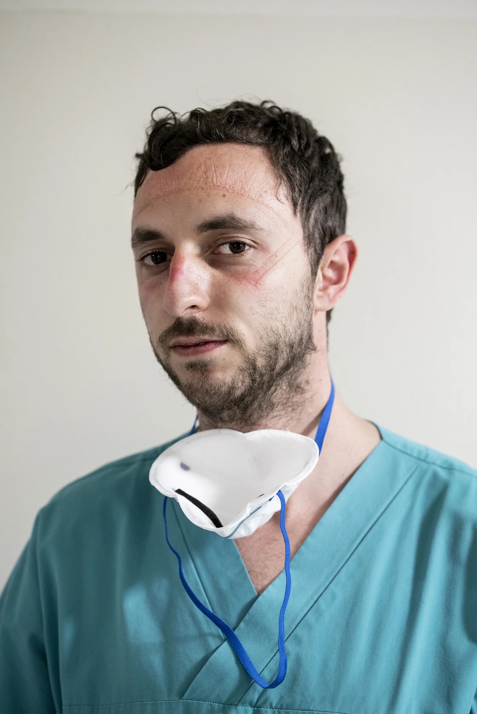 Healthcare worker with marks on face from wearing personal protective equipment.