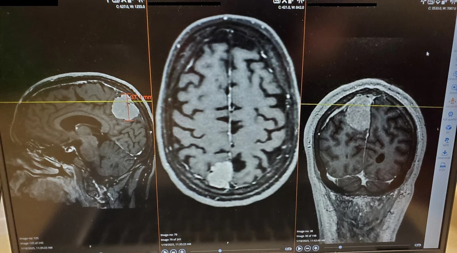 Brain MRI scans displaying different views of a tumor within the brain tissue.