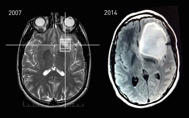 MRI scans showing a brain in 2007 and a brain with a large tumor in 2014.