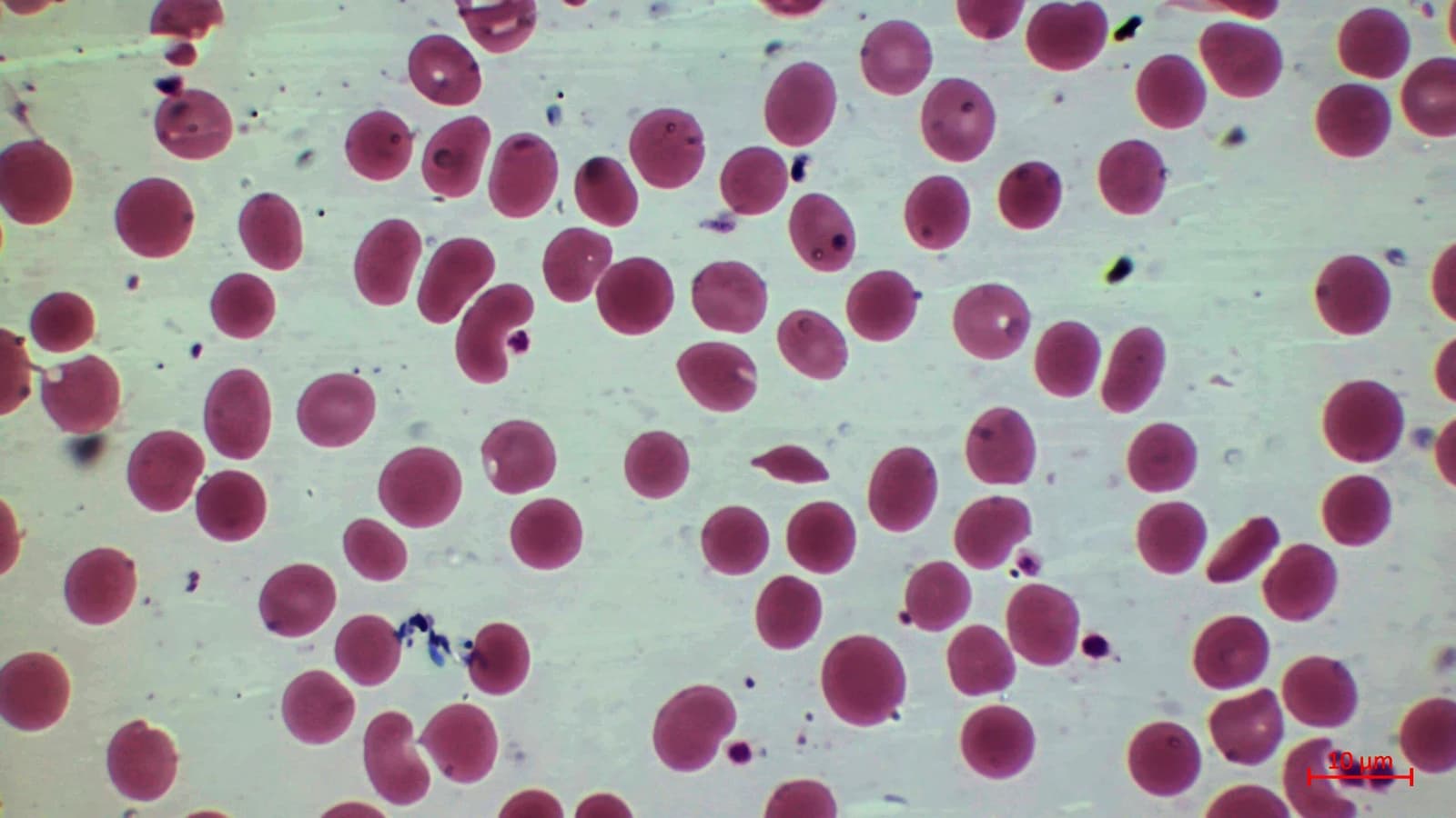 Microscopic image shows red blood cells with some irregularly shaped cells.